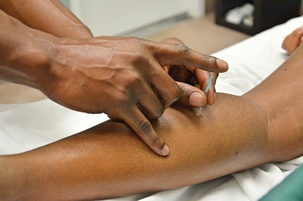 Découvrez les bienfaits insoupçonnés de l'acupuncture