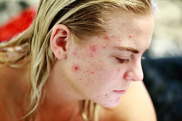 Reconnaître les Signes d'une Allergie aux Médicaments : Ce que Vous Devez Savoir